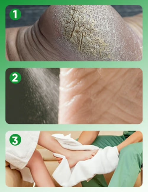 Kovettumia poistava jalkasuihke