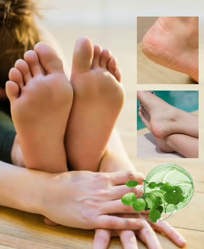 Kovettumia poistava jalkasuihke